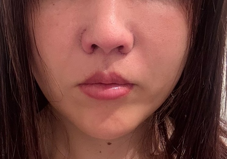 after photo: ピコトーニング
