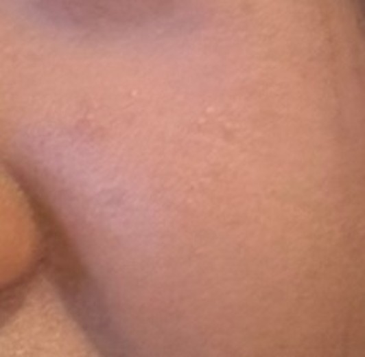 before photo: PRP피부재생술