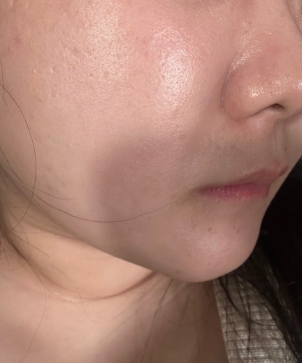 before photo: チタニウムリフト