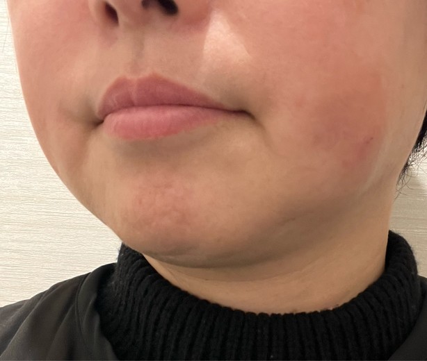 after photo: 脂肪溶解注射(太もも)