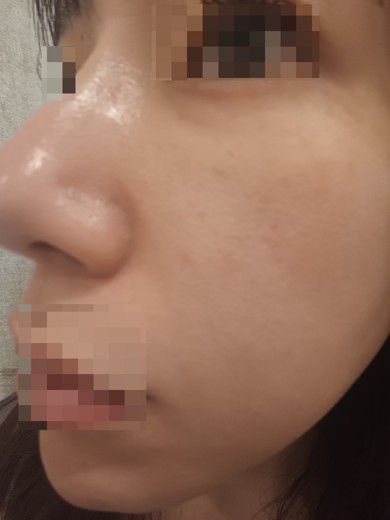 after photo: IPL(光/フォト治療), ピーリング, エレクトロポレーション