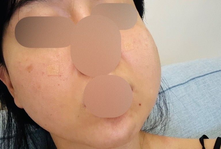 after photo: PRP피부재생술