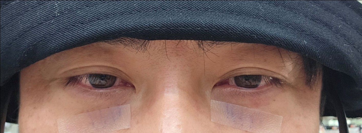 after photo: 눈밑지방재배치