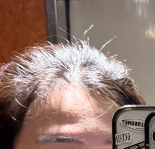 before photo: 이마필러