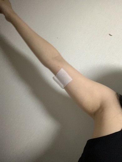 after photo: 팔지방분해주사