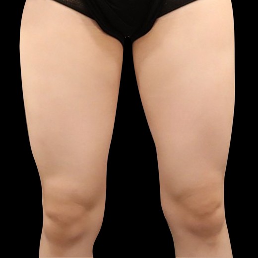 before photo: 허벅지지방분해주사