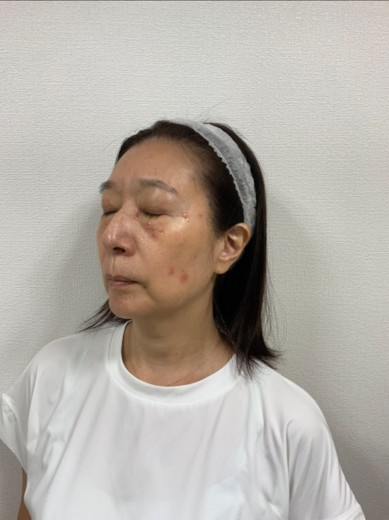 before photo: ピコスポット