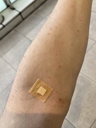 after photo: エクソソーム, 美容注射・点滴