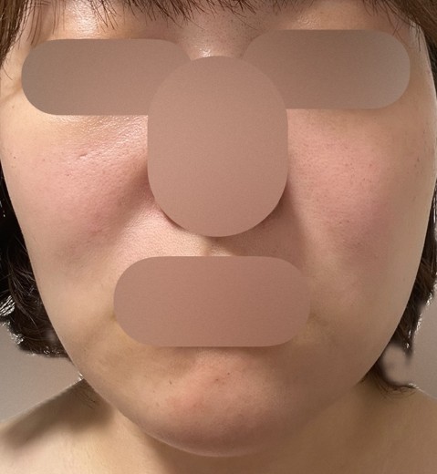 after photo: ルメッカ
