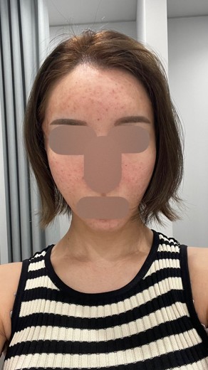 after photo: 糸リフト