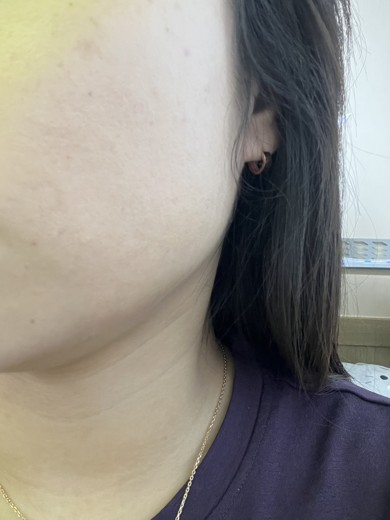 after photo: 사각턱보톡스