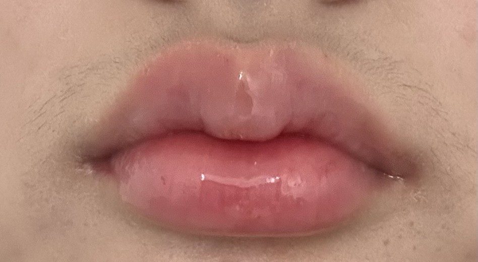 after photo: 입꼬리필러, 입술필러
