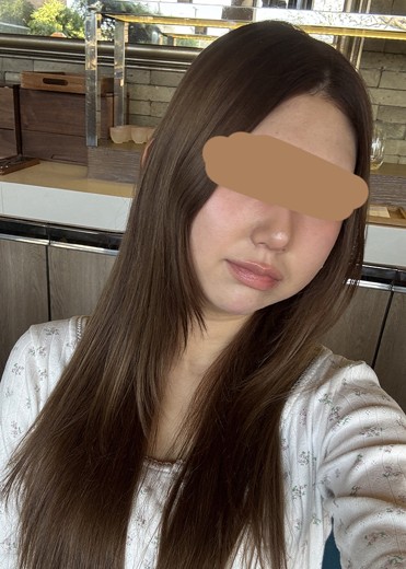 before photo: チューンフェイス(リフトアップ), 脂肪溶解注射(顔)