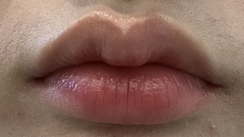 after photo: 입꼬리필러, 입술필러