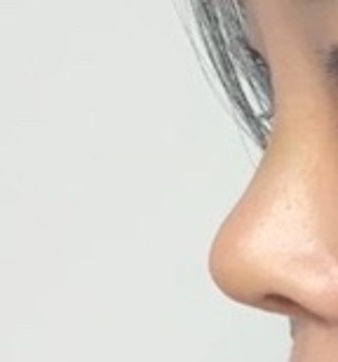 after photo: 콧대(보형물), 코끝(자가연골)