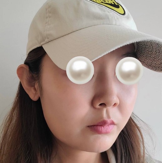 before photo: 울쎄라피프라임