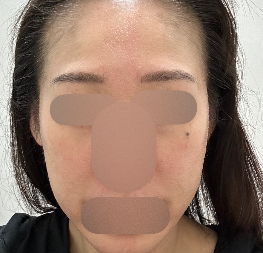 マッサージピール＋エレクトロポーション【再来OK】 | ライズワン美容