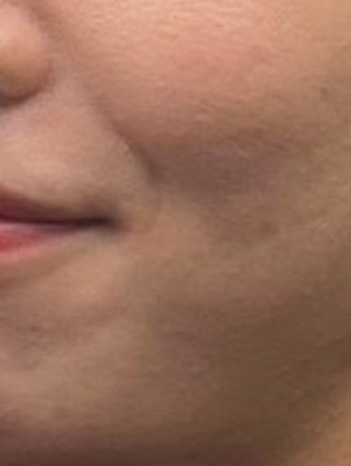 before photo: ダーマペン