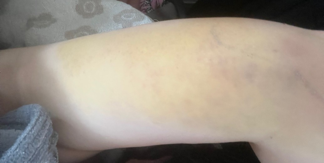 after photo: 脂肪吸引(腕)