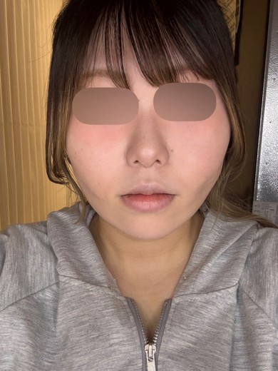 after photo: 糸リフト, 脂肪吸引(顎下), 脂肪吸引(顔), 脂肪吸引(頬)
