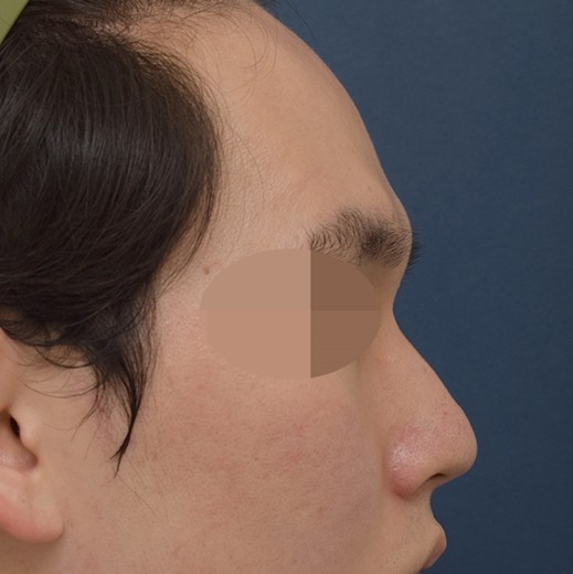 before photo: 콧대(자가조직), 코끝(자가연골)