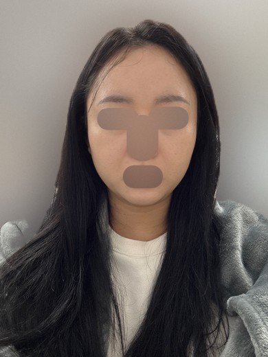 after photo: 온다리프팅