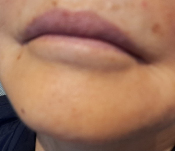 before photo: 윤곽주사, 얼굴지방분해주사