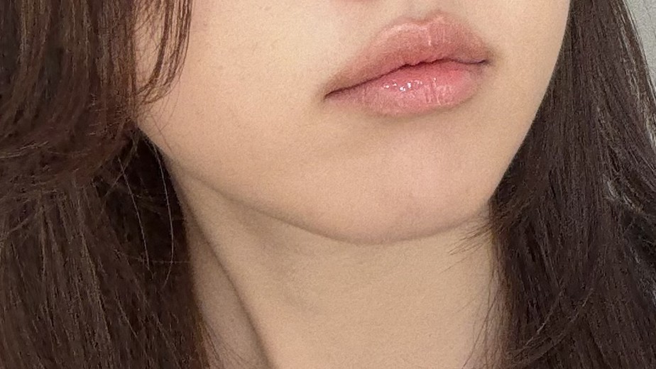 before photo: 윤곽주사, 사각턱보톡스