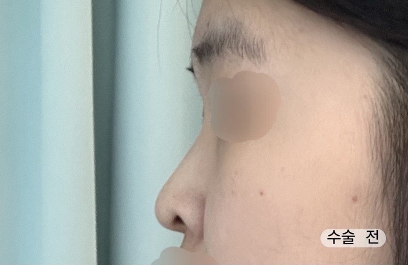 before photo: 콧대(자가조직), 코끝(자가연골)