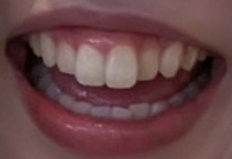 before photo: ホワイトニング