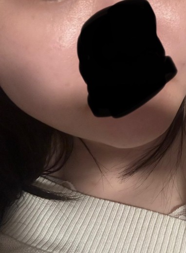 after photo: チタニウムリフト