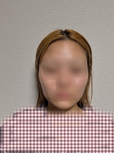 after photo: インモード