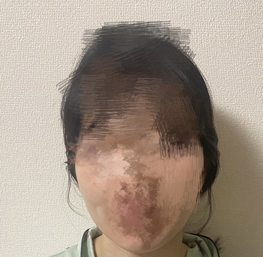 after photo: チタニウムリフト