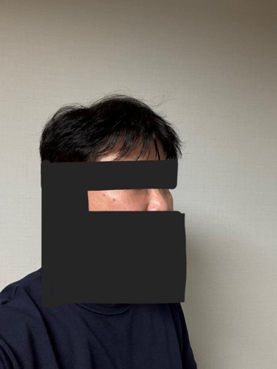 after photo: 눈밑지방재배치