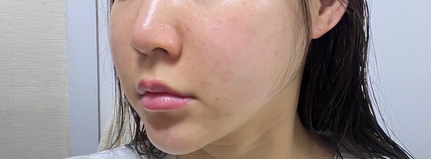 after photo: PRP피부재생술