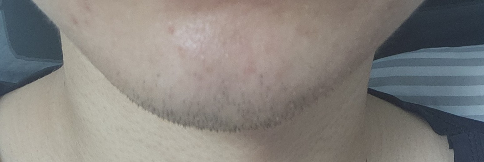 after photo: 턱끝필러