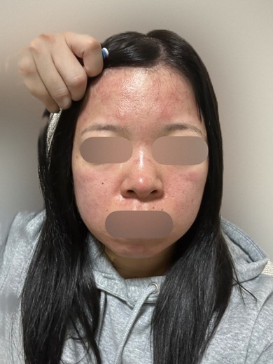 after photo: ダーマペン
