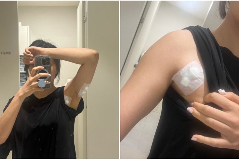 after photo: 팔지방분해주사