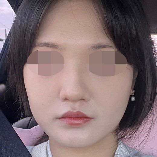 after photo: 콧볼축소