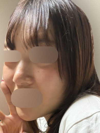 before photo: ピコフラクショナル