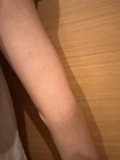 after photo: 脂肪溶解注射(腕)