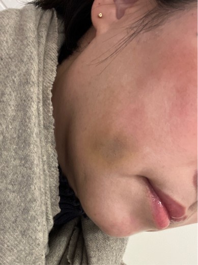 after photo: 脂肪溶解注射(太もも)