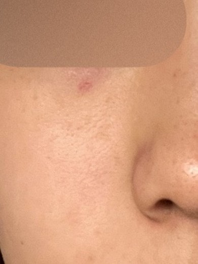 after photo: CO2レーザー, ほくろ除去(レーザー)