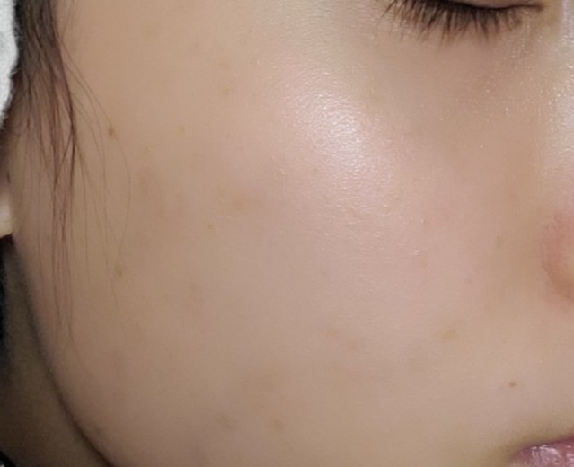 after photo: 白玉注射・点滴