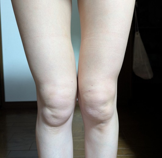 after photo: 脂肪溶解注射(太もも)
