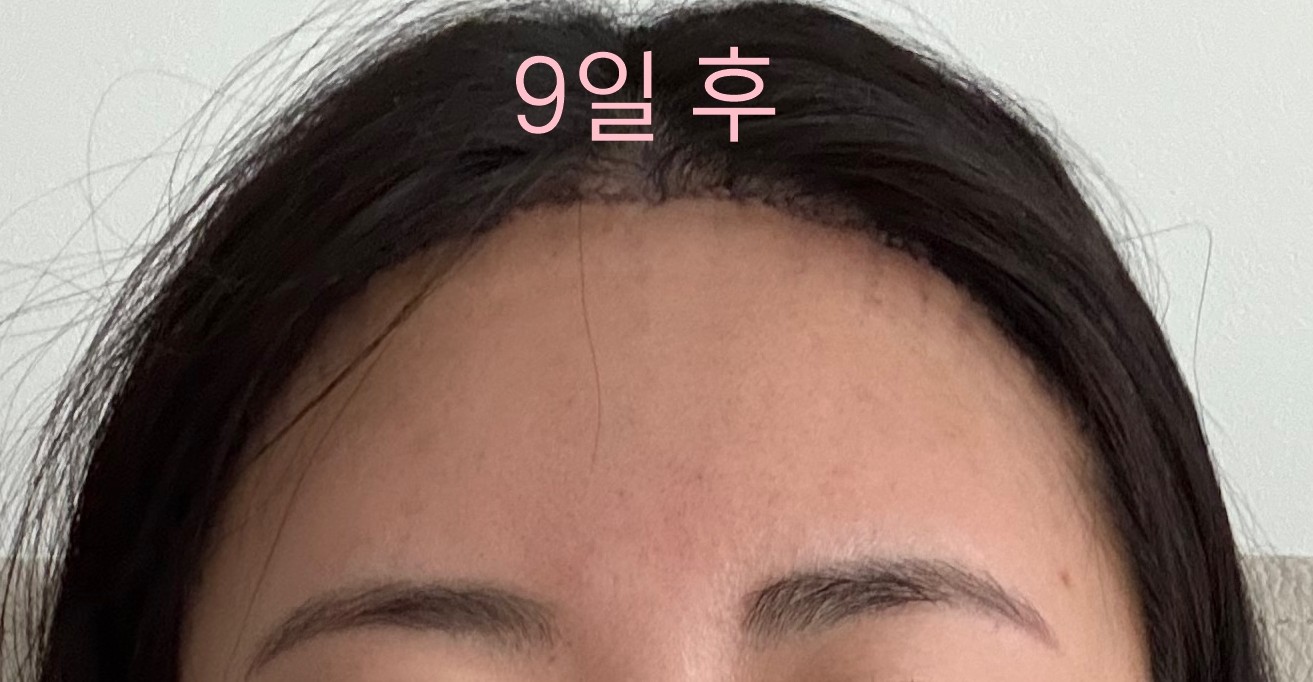 시술 후