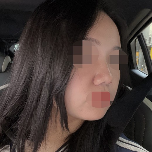 before photo: 콧볼축소