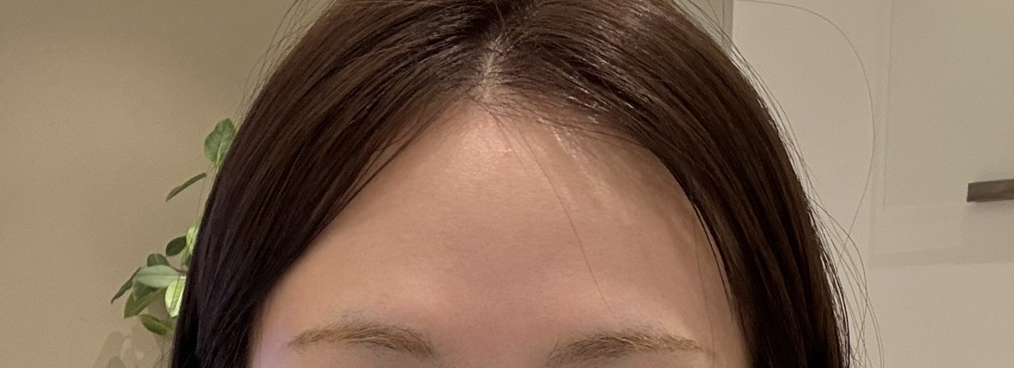 before photo: 이마필러