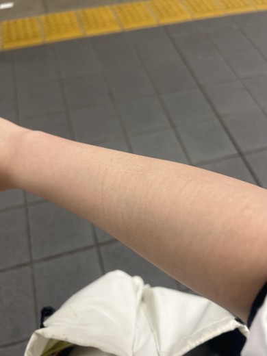 after photo: 白玉注射・点滴