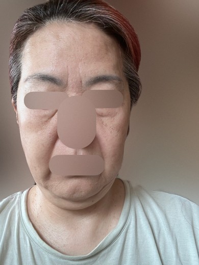 before photo: 脂肪溶解注射(顔)